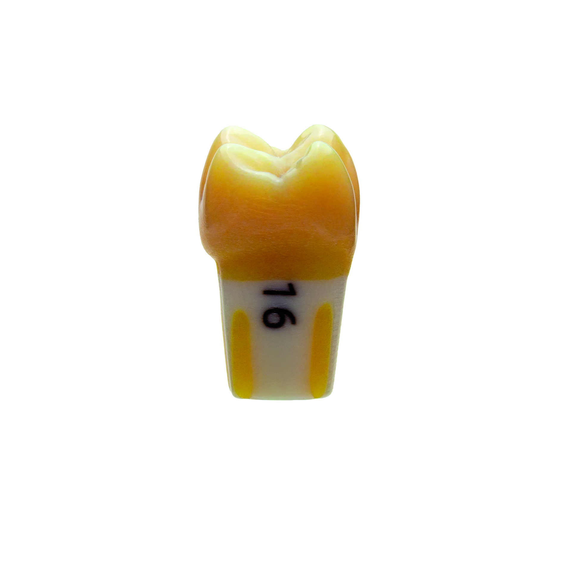 myteeth Übungszahn 16, Fissurenkaries - 4