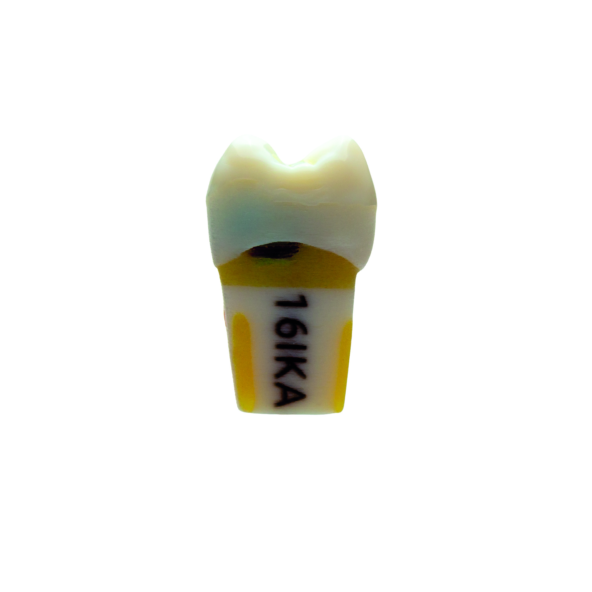 myteeth Übungszahn 16 mit insuffizienter Krone und Sekundärkaries mesial - 2