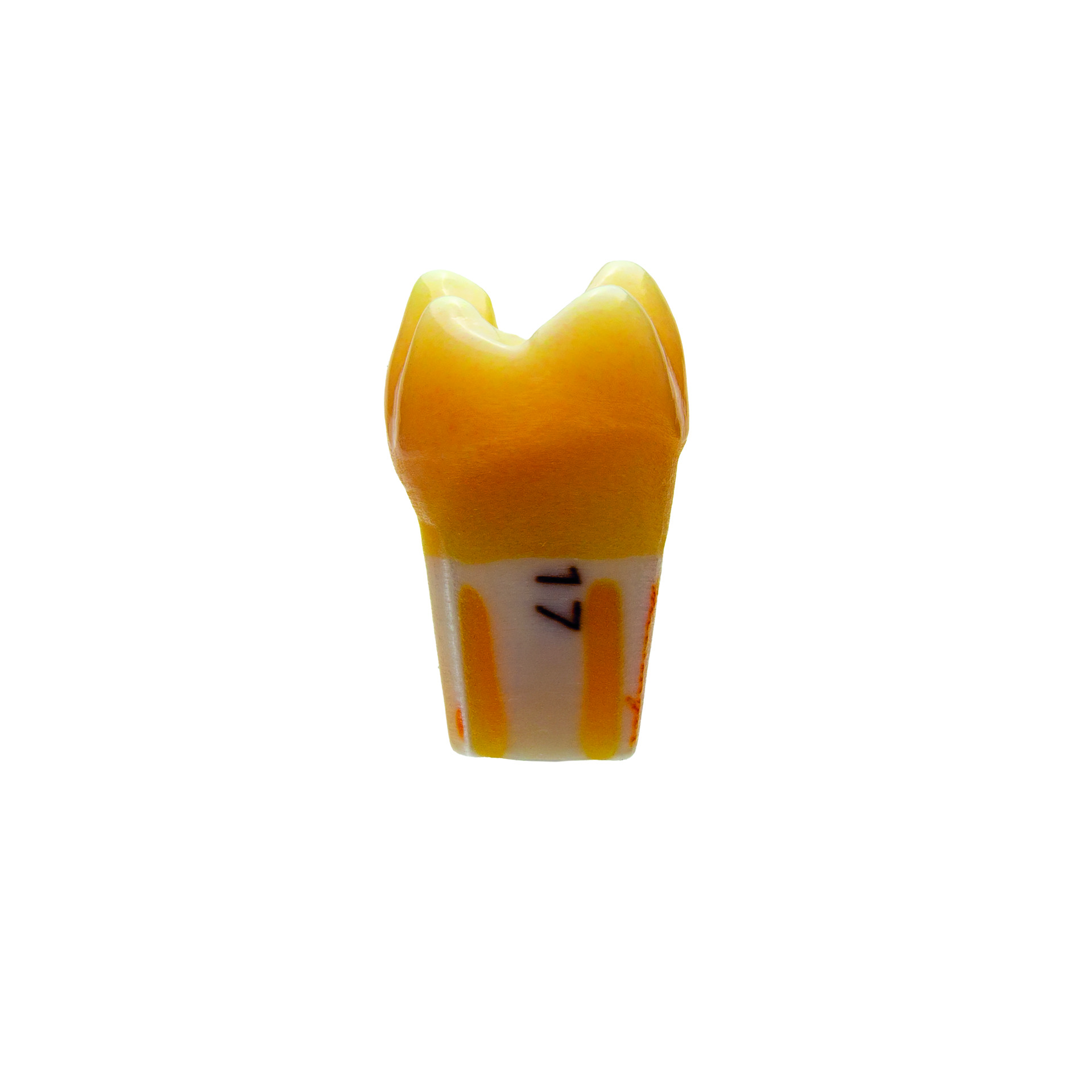 myteeth Übungszahn 17, mit MO Inlay Präparation - 5