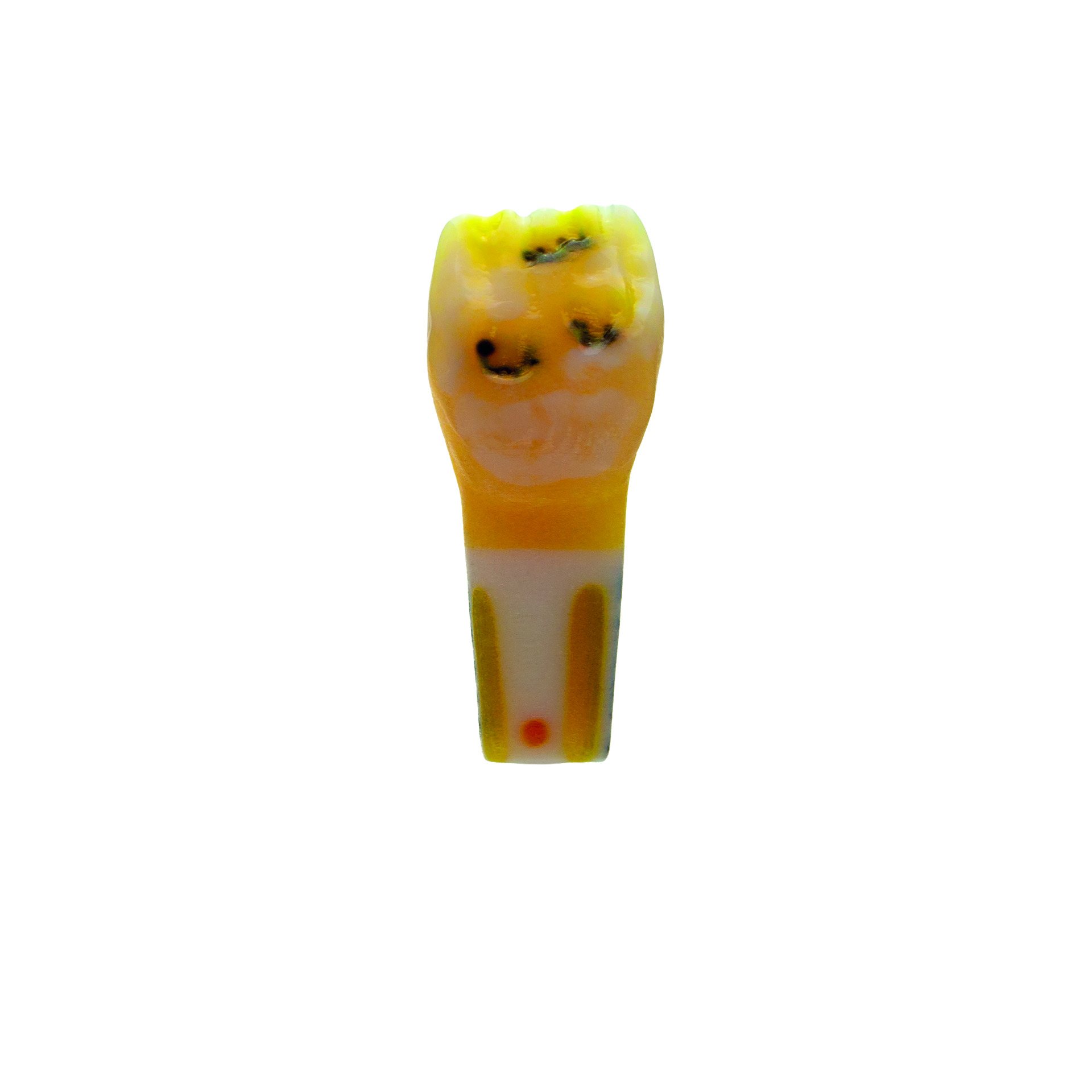 myteeth Übungszahn 21, Amelogenesis Imperfecta